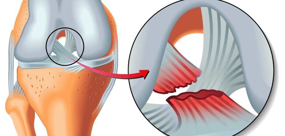 osteoartrita primară a genunchiului